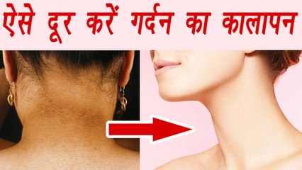 Скачать видео: Dark Neck Home Remedies | ऐसे दूर करें गर्दन का कालापन | Boldsky