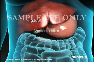 Colecistectomía (extirpación de la vesícula biliar) - YouTube