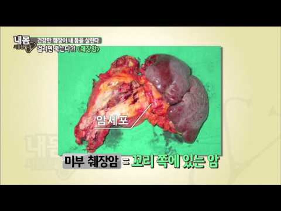 췌장암, 걸리면 죽는다?! [내몸사용설명서] 41회 20150312