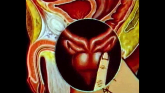 Массаж простаты в домашних условиях. Как правильно делать массаж простаты. Массажер для простаты