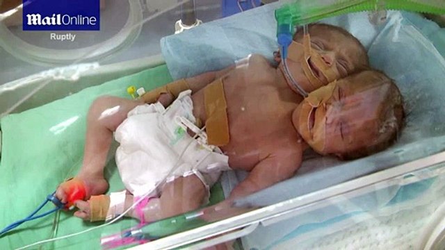 Nghị lực sống phi thường của hai chị em sinh đôi bị dính liền nhau