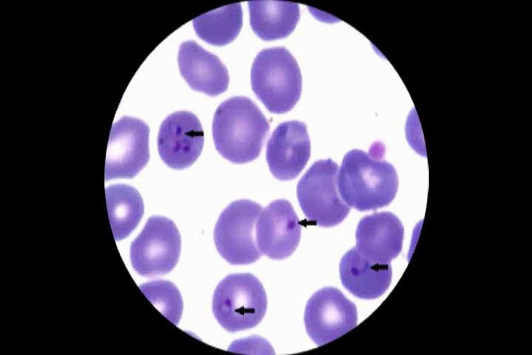 Trofozoítas de Plasmodium falciparum no interior das hemácias