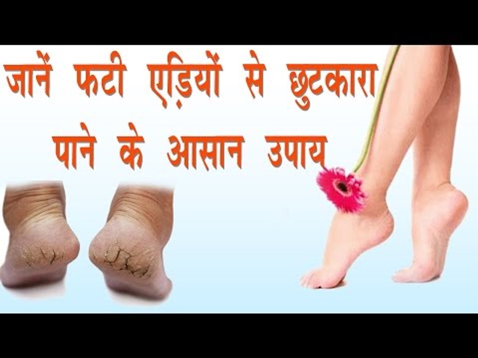 जानें फटी एड़ियों से छुटकारा पाने के आसान उपाय || Home Remedies For Cracked Heels