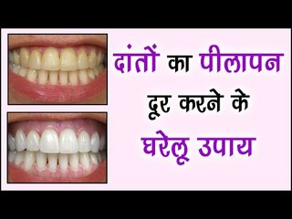 दांतों का पीलापन दूर करने के घरेलू उपाय || Natural Teeth Whitening Treatment || Arogya India
