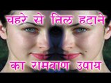 चेहरे से तिल हटाने का रामबाण उपाय || How To Remove Flat Moles From Face || Health Tips