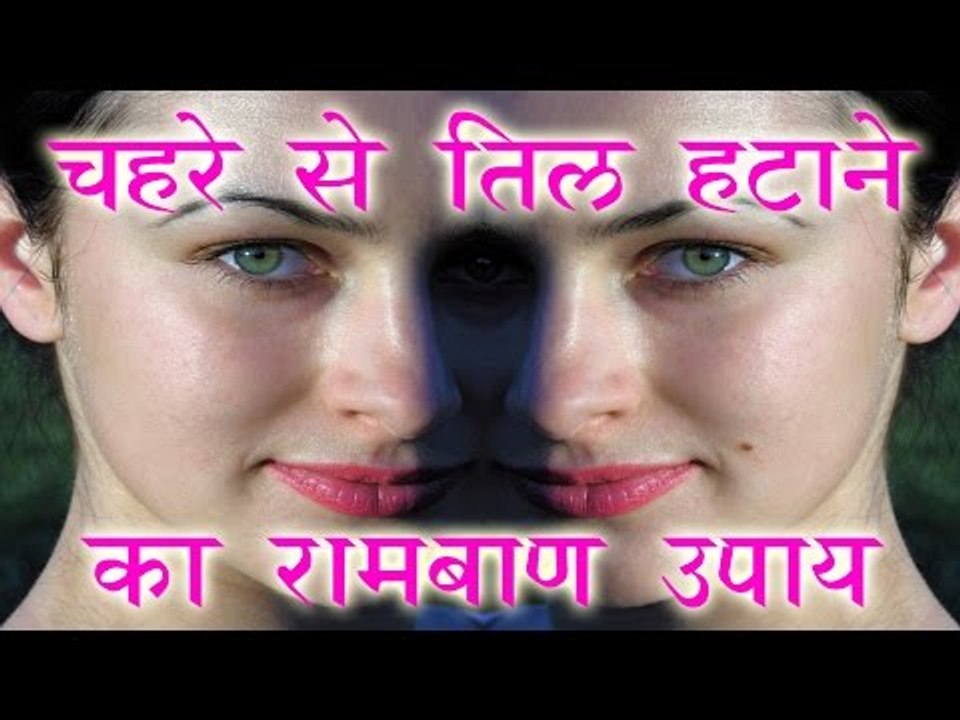 चेहरे से तिल हटाने का रामबाण उपाय || How To Remove Flat Moles From Face || Health Tips