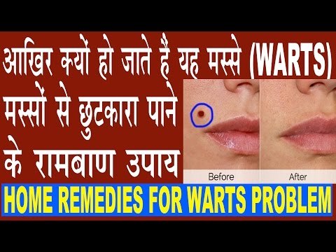 मस्सों को हटाने के रामबाण उपाय | Warts Removal Home Remedies | Masso Ka Gharelu Ilaj