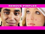 How to Clear Pimples/Acne|मुहांसों से छुटकारा कैसे पायें|muhanso ko dur karna ke upaya|Subtitles
