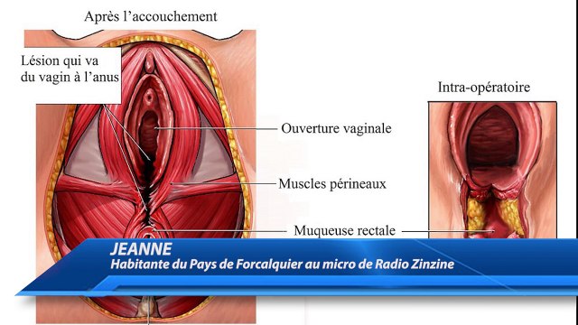 Une patiente accable un chirurgien du CH de Manosque : « il a suturé mes  lèvres dans mon vagin »