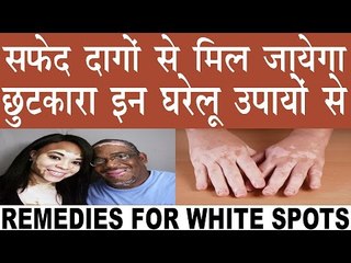 सफेद दागों से ना हों अब परेशान, होगा इन उपायों से समाधान | Home Remedies Of White Spots In Hindi