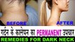 गर्दन के कालेपन को दूर करने के उपाय |Home Remedies For Dark Neck In Hindi|Gerdan ke Kalapan ka Ilaj