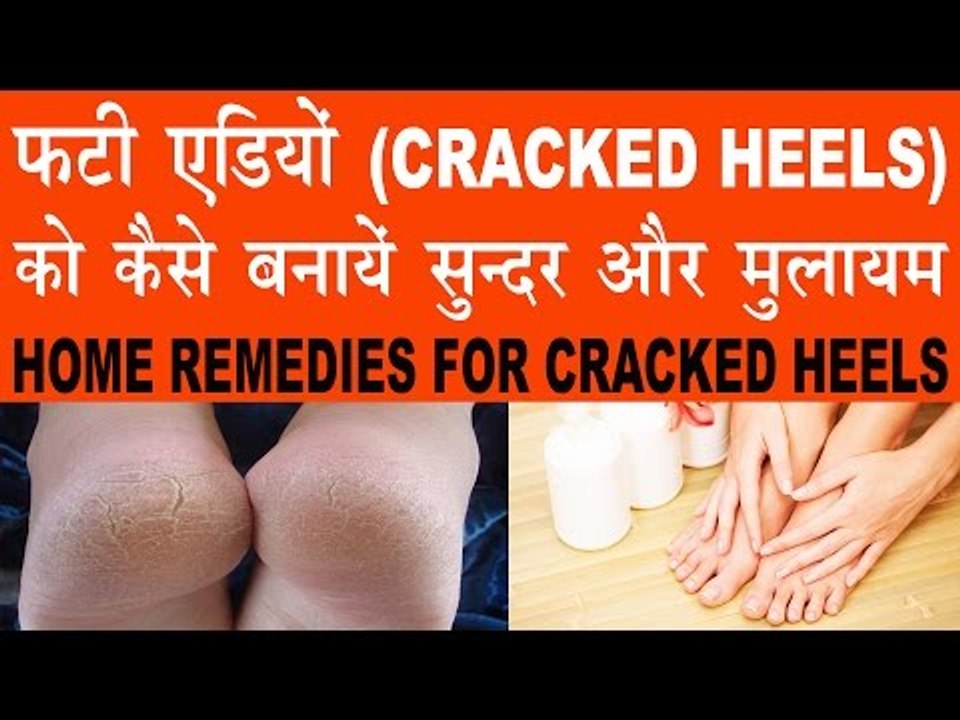फटी एड़ियां (CRACKED HEELS) को कैसे बनायें मुलायम | Home Remedies For Cracked Heels In Hindi