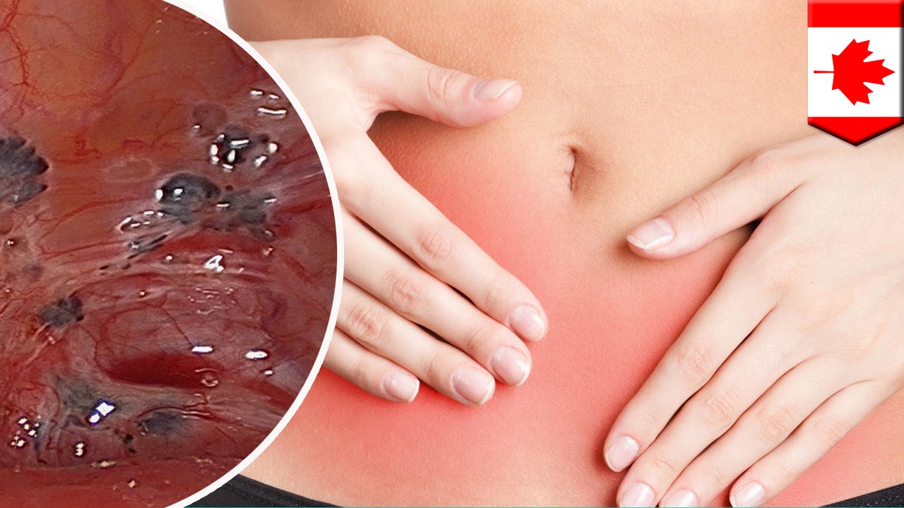 What is endometriosis?