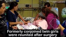 The moment conjoined twins see each other