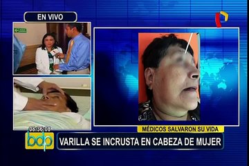 Hospital Dos de Mayo: médicos salvan a mujer al extraerle varrilla que se incrustó en su rostro