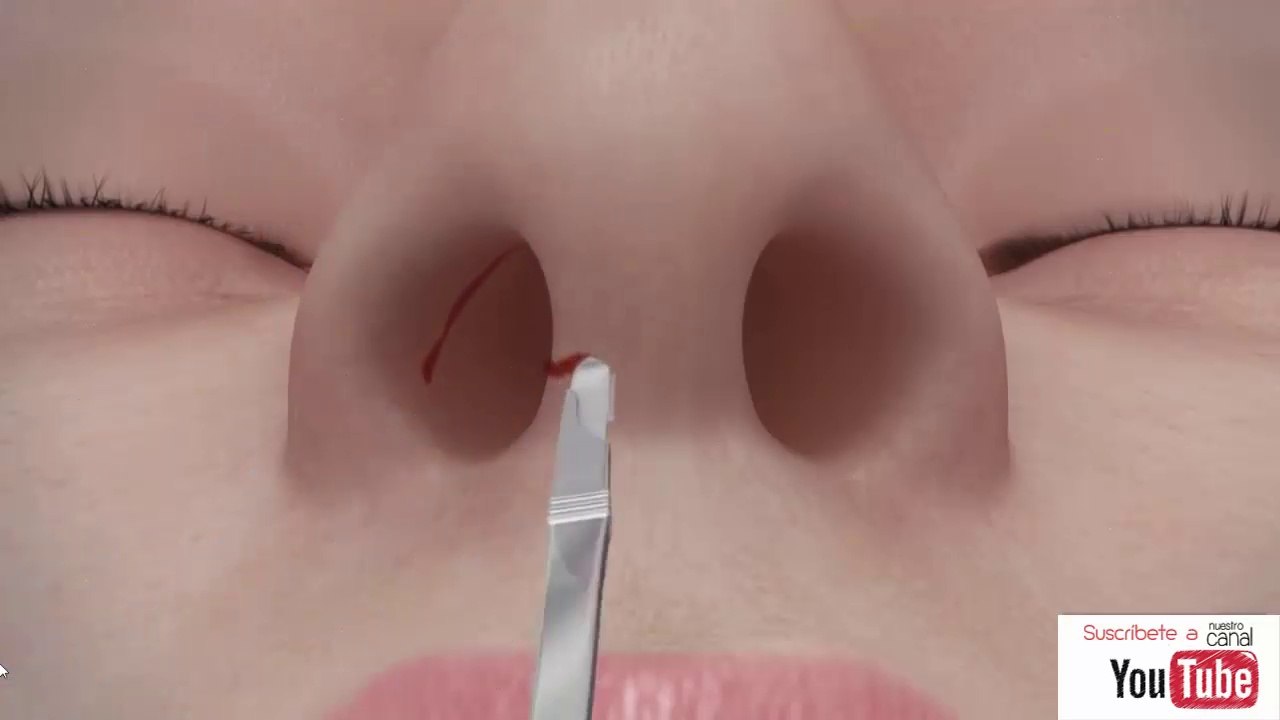 RINOPLASTIA - CONOCE EL PROCEDIMIENTO