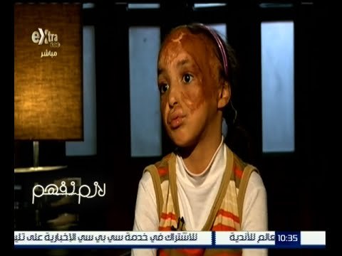 لازم نفهم | تقرير - نقص الرعاية الطبية والاجتماعية لضحايا الحروق