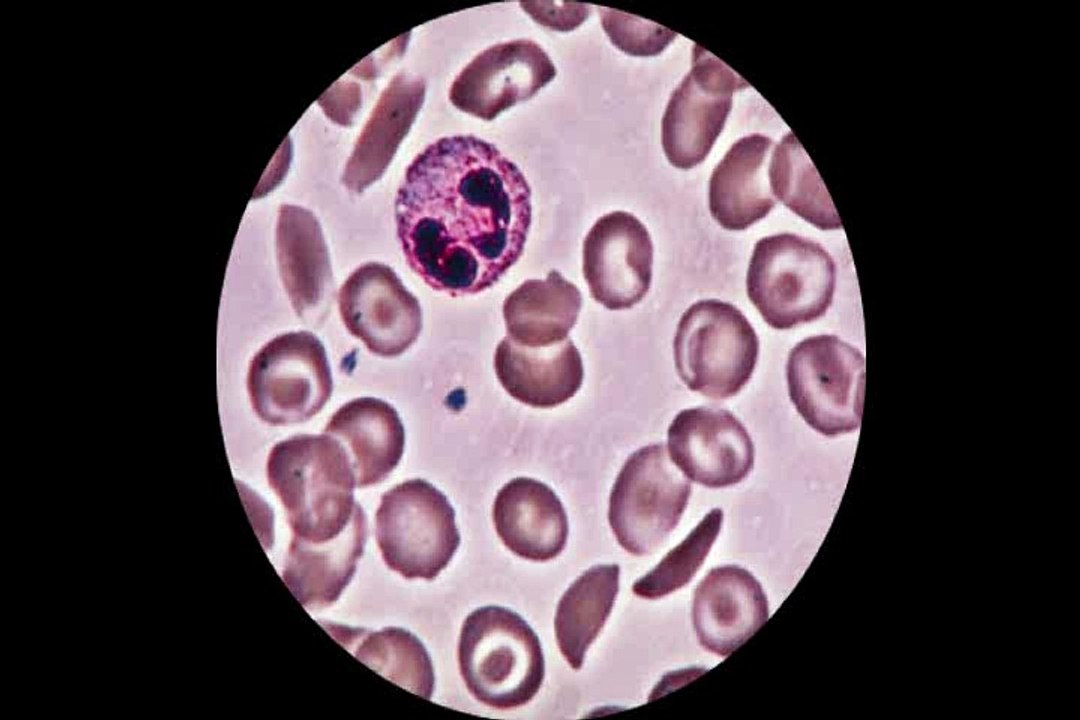 sangue paciente com anemia falciforme