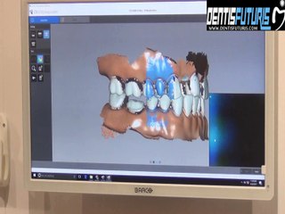 #IDS2017 : le scanner intra oral CS3600 sur le Stand Carestream Dental