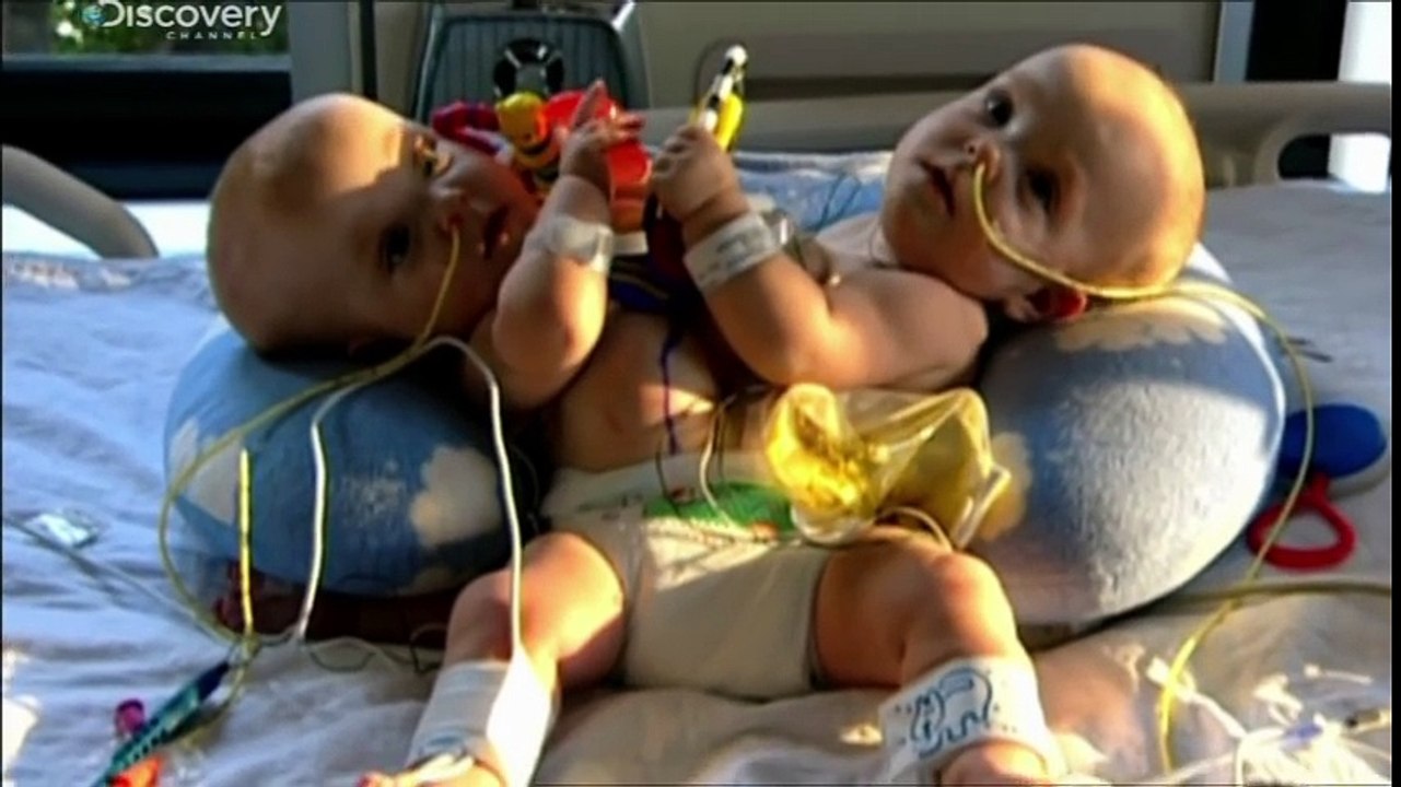 L'incroyable destins de ces jumelles siamoises