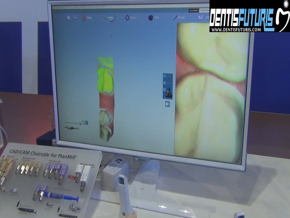 #IDS2017 : démonstration du scanner intra-oral Plascan Emerald