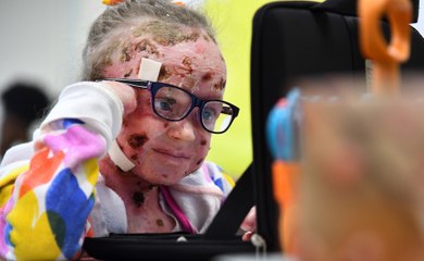 Meet Ella Murray: The 9-year-old with skin as delicate as a butterfly's wing