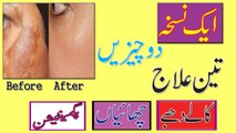 How To Remove Pigmentation Freckles And Acne Scars Instantly