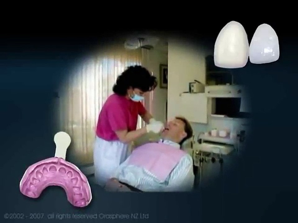 Veneers PEV video