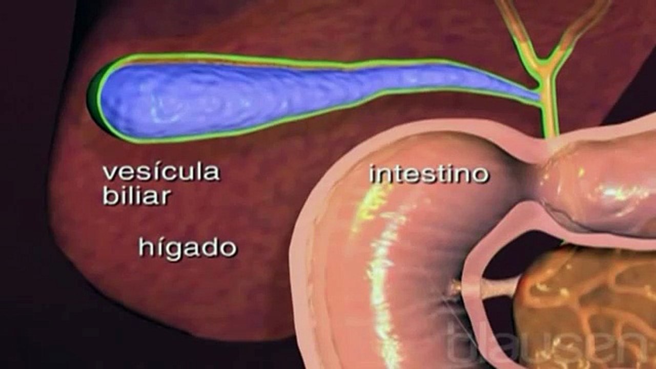 ¿Por qué se forman los cálculos en la vesícula?