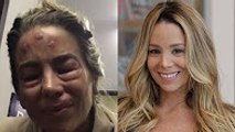 DANI WINITS APARECE COM ROSTO DESFIGURADO E AMIGA DIZ: 'VAI NA DELEGACIA' (Ls News)