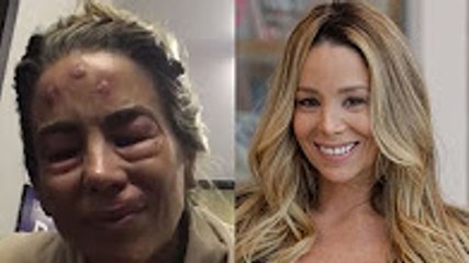 DANI WINITS APARECE COM ROSTO DESFIGURADO E AMIGA DIZ: 'VAI NA DELEGACIA' (Ls News)