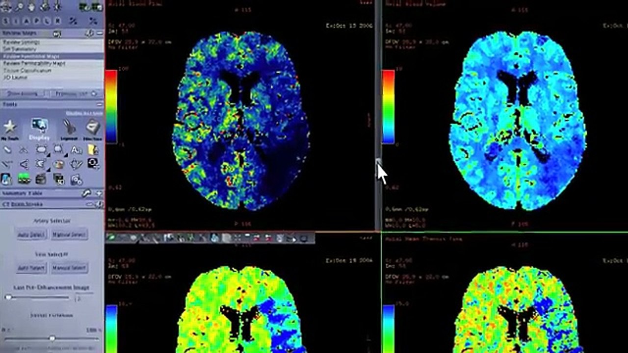GE   AW + perfusion 4D CT Ex