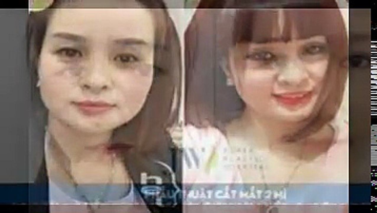 Nhấn mí Hàn Quốc đem lại cho bạn đôi mắt thu hút ánh nhìn