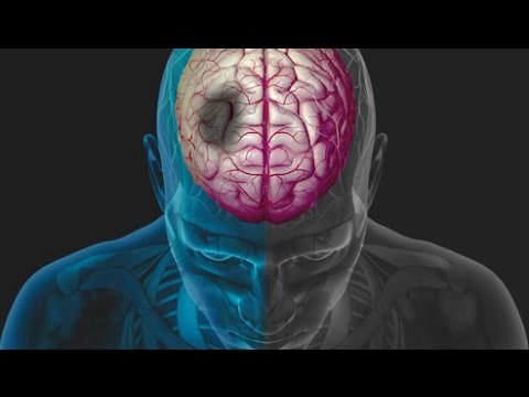 Señales tempranas de un infarto cerebral