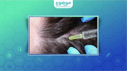 علاج مرض الثعلبة