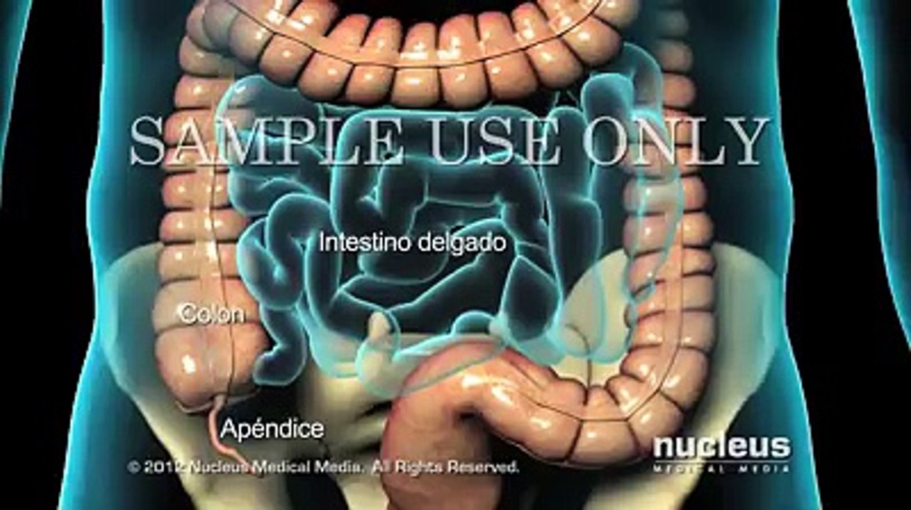APENDICITIS AGUDA