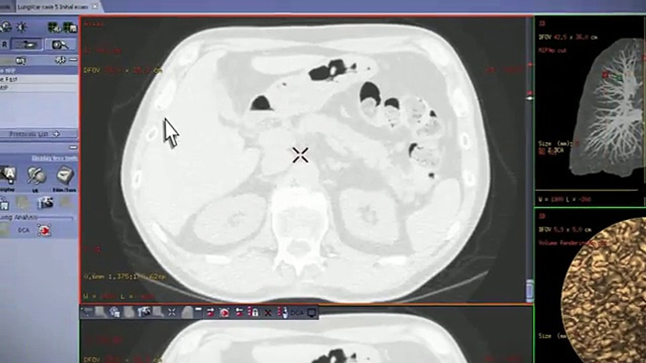 Lung VCAR