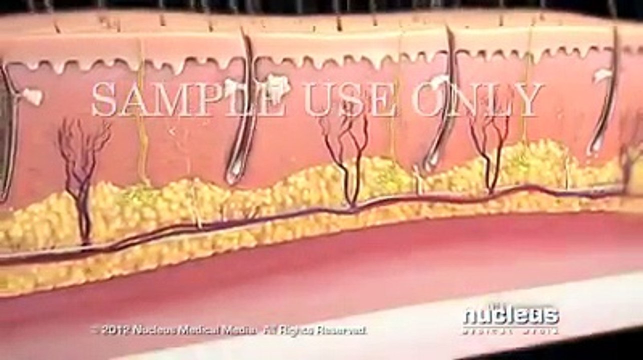 QUEMADURAS Y CLASIFICACIÓN SEGÚN GRADOS