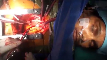 Le moment flippant où une femme se réveille durant une opération à coeur ouvert