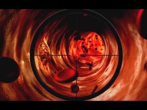 Napoli - Cancro, diagnosi precoce con la Biopsia Liquida (11.07.17)