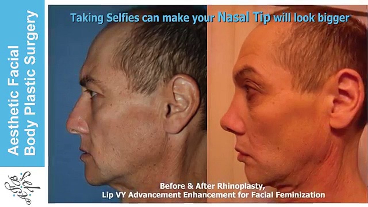 RHINOPLASTY & BEAUTY THEORY EXPLAINED, WITH TOPICS ON THE CROOKED NOSE, NASAL HUMPS, ASIAN NOSE