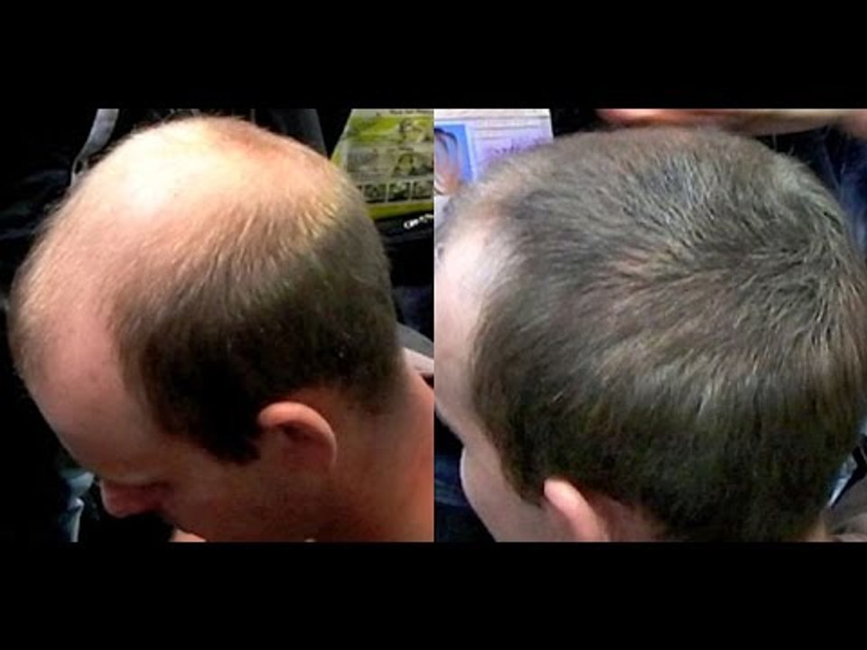 Caboki hair loss concealer get Caboki hair fiber today a hair loss solution - Caboki hair