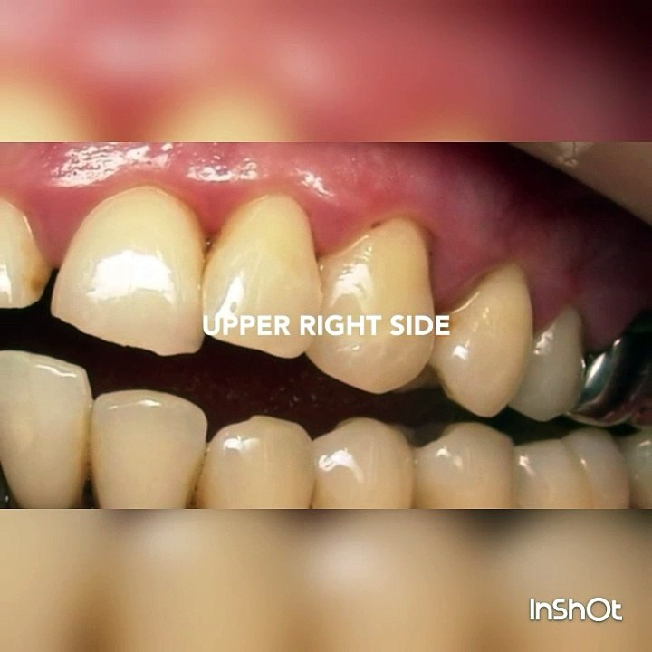 How to Periodontal Disease and Receding Gums Treatment