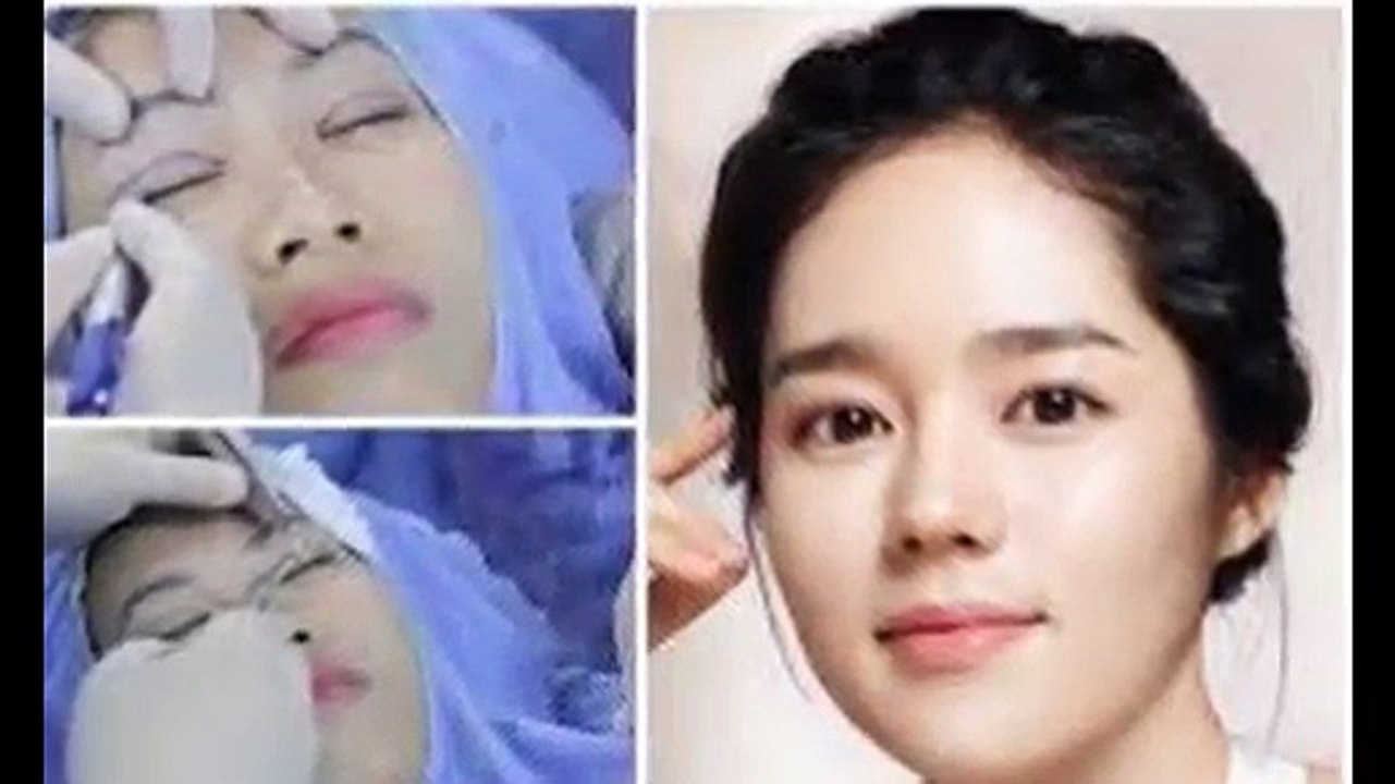 Cắt mí mắt để có một đôi mắt hoàn hảo