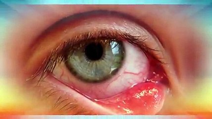 Técnicas para curar los orzuelos rápidamente