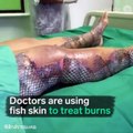 ตะลึง! แพทย์บราซิลใช้หนังปลานิล รักษาคนไข้ไฟไหม้ ทดลองใช้กับคนไข้แล้วกว่า 50 คน