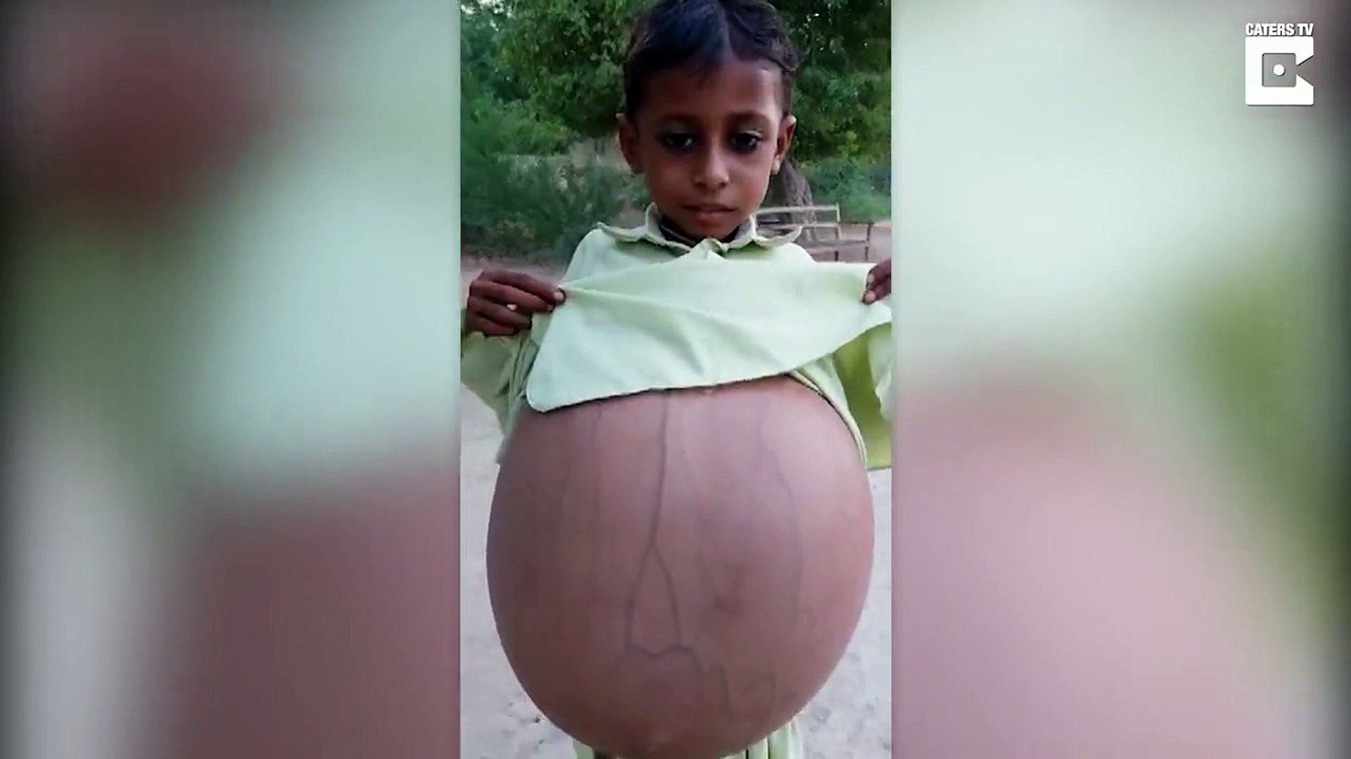 Ce Jeune Pakistanais De 9 Ans Avec Le Ventre Hyper Gonfle Attend Une Operation Pour Lui Sauver La Vie Video Dailymotion