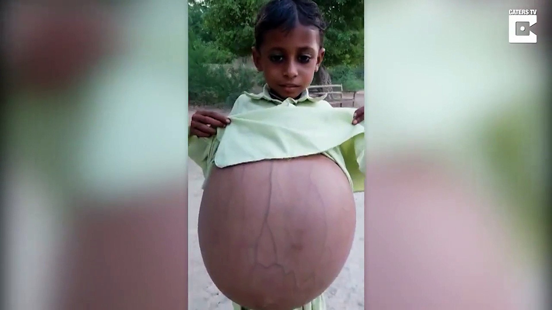 Cet Enfant Pakistanais Au Ventre Surgonfle Va Etre Opere Car Sa Vie Est En Danger Video Dailymotion