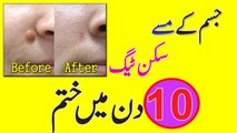 Home Remedy To Remove Skin Tags || Anam Home Remedy