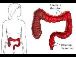 ¿Cómo eliminar la colitis? / Remedios para la colitis